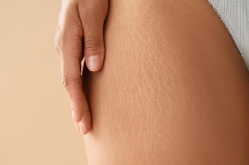 Nahaufnahme einer Oberschenkelhaut mit Dellen, Thema: Cellulite loswerden.