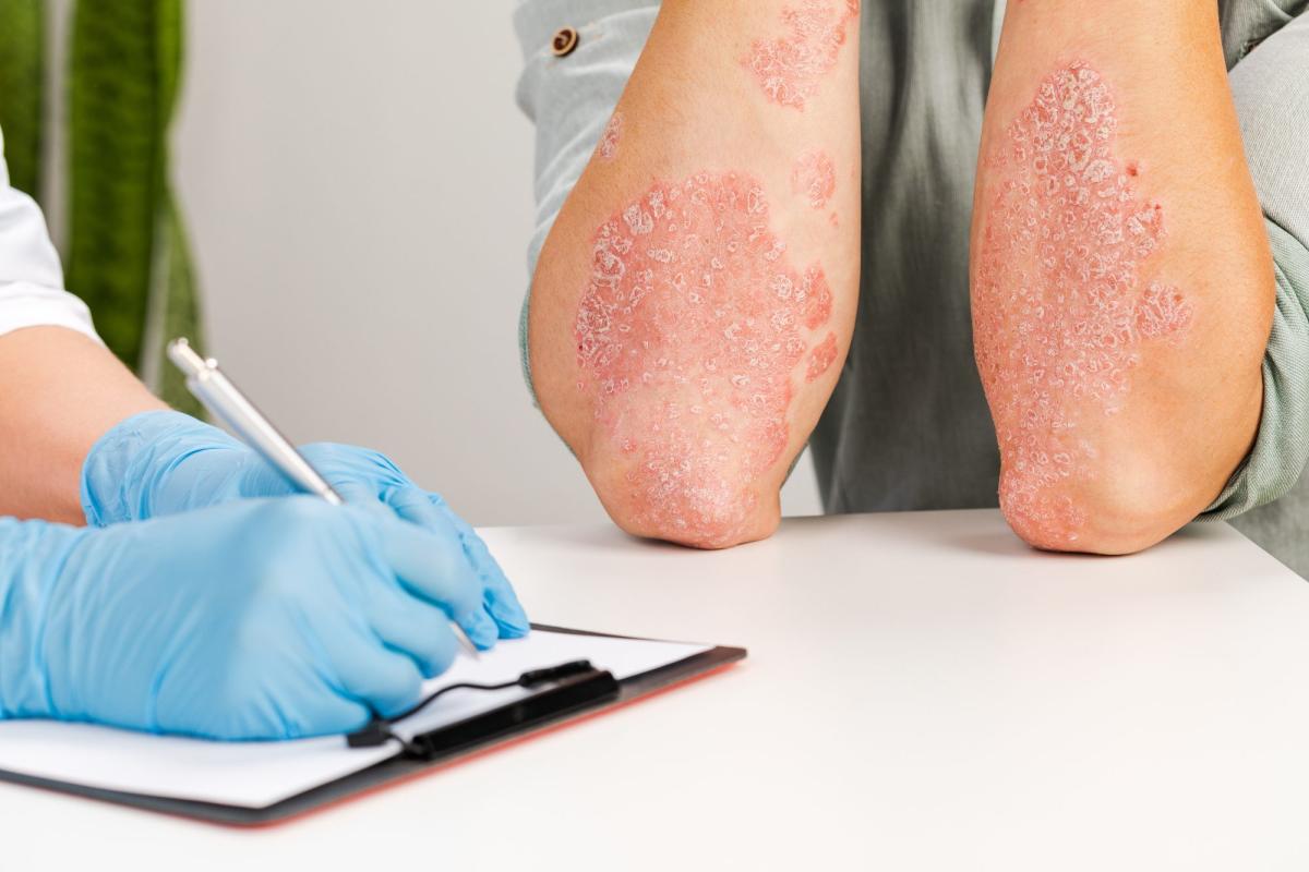Moderne Hautarztpraxen arbeiten heutzutage mit hochmodernen biologischen Medikamenten