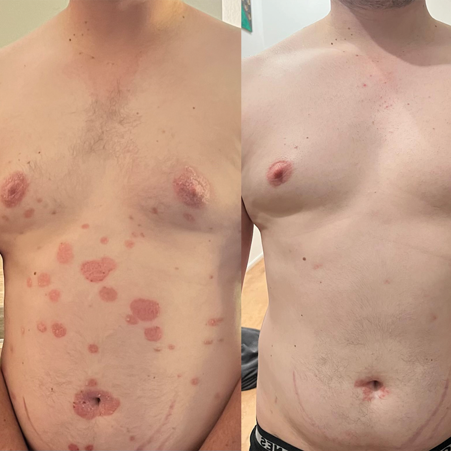 Von blutigen Psoriasis-Plaques zu freier Haut: Mit Plan und System zu mehr Lebensqualität