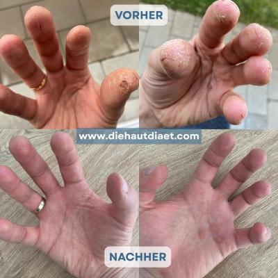 Neurodermitis an den Fingerspitzen geheilt