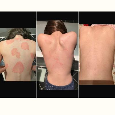 Von großflächiger Schuppenflechte (Psoriasis) zu natürlich gesunder Haut in nur 8 Wochen